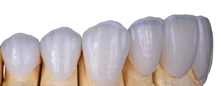 Natural Dental Lab | Veneers on refractor Natural Dental Lab | Veneers on refractor