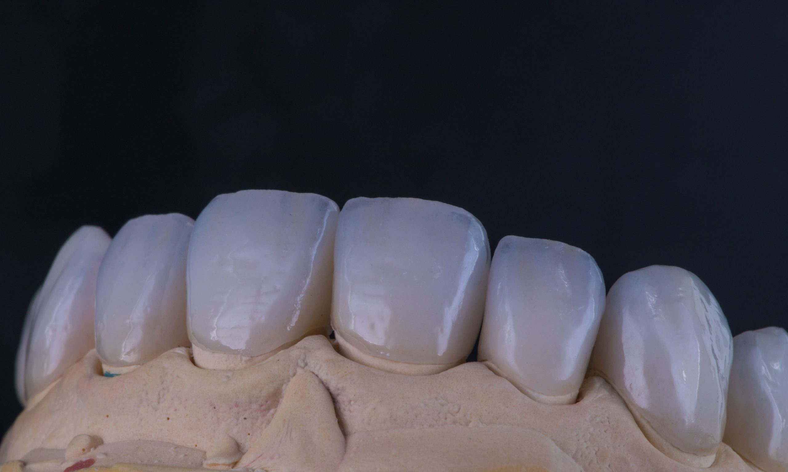 Natural Dental Lab | Veneers Natural Dental Lab | Veneers